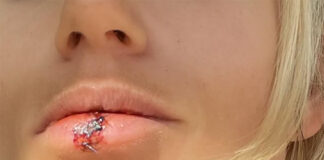 アンナ・ガッサー 衝撃的な唇の傷「私は必ずリベンジする」